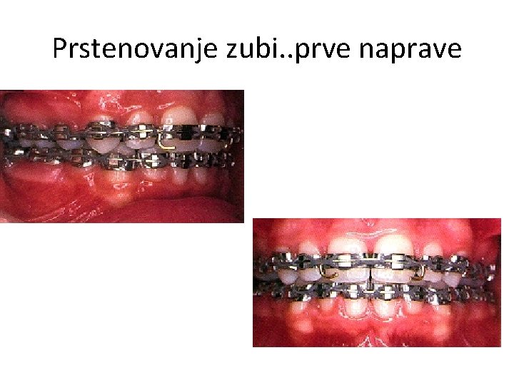 Prstenovanje zubi. . prve naprave 