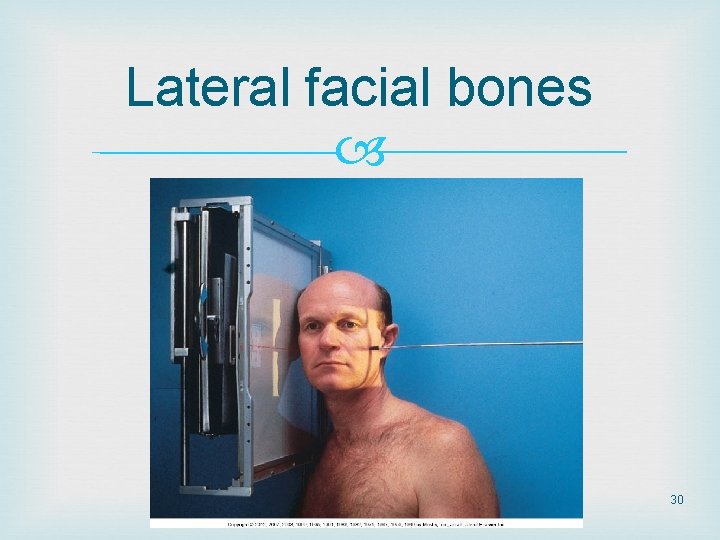 Lateral facial bones 30 Lateral facial bones 30