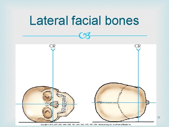 Lateral facial bones 31 Lateral facial bones 31