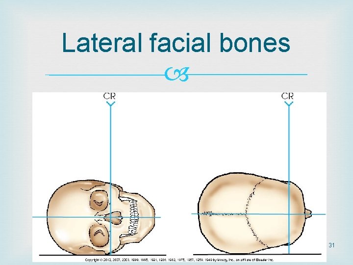 Lateral facial bones 31 