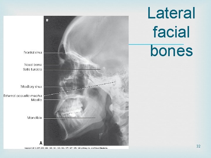 Lateral facial bones 32 Lateral facial bones 32