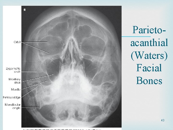  Parietoacanthial (Waters) Facial Bones 43 