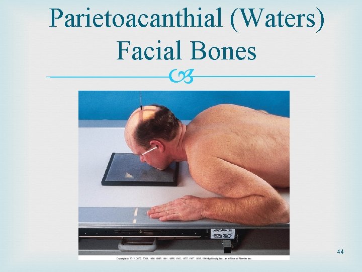 Parietoacanthial (Waters) Facial Bones 44 Parietoacanthial (Waters) Facial Bones 44
