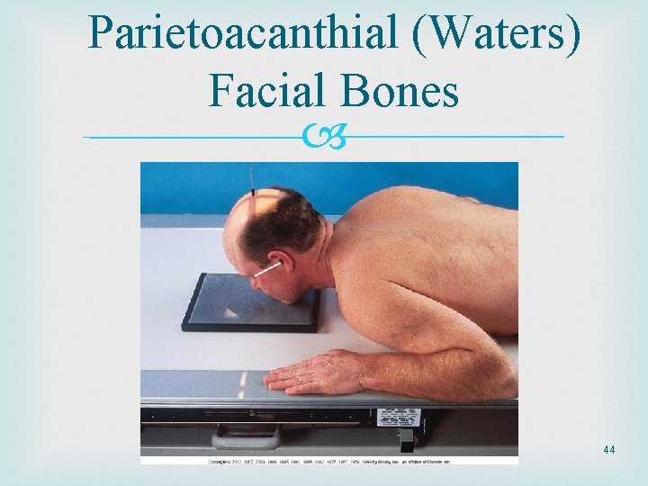 Parietoacanthial (Waters) Facial Bones 44 