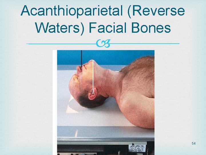 Acanthioparietal (Reverse Waters) Facial Bones 54 