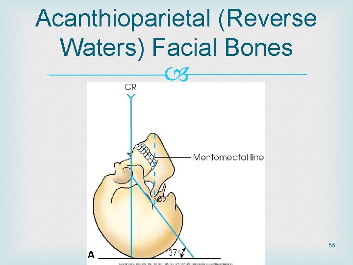 Acanthioparietal (Reverse Waters) Facial Bones 55 