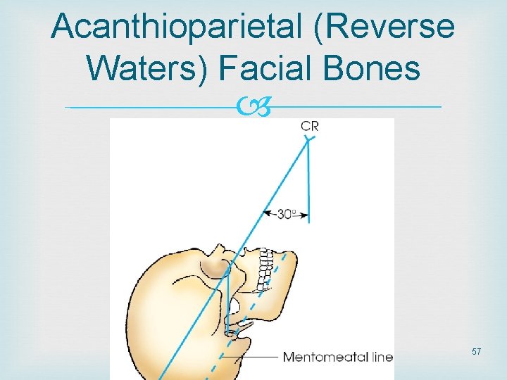 Acanthioparietal (Reverse Waters) Facial Bones 57 