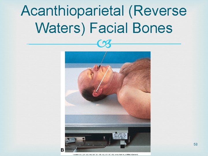 Acanthioparietal (Reverse Waters) Facial Bones 58 