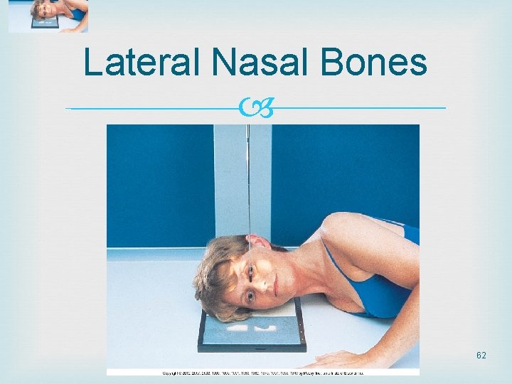 Lateral Nasal Bones 62 Lateral Nasal Bones 62
