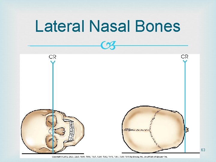 Lateral Nasal Bones 63 Lateral Nasal Bones 63