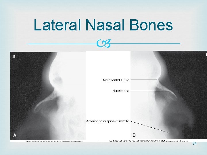 Lateral Nasal Bones 64 Lateral Nasal Bones 64