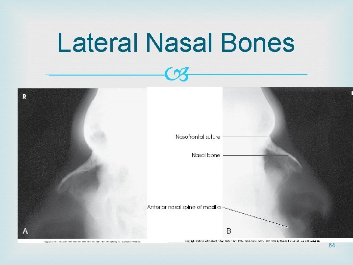 Lateral Nasal Bones 64 