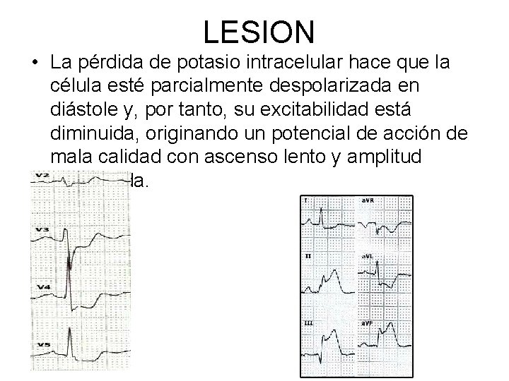 LESION • La pérdida de potasio intracelular hace que la célula esté parcialmente despolarizada