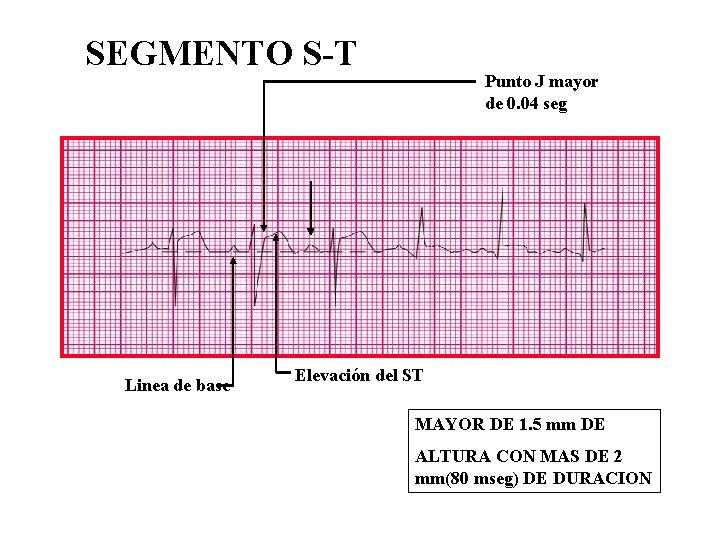 SEGMENTO S-T Linea de base Punto J mayor de 0. 04 seg Elevación del