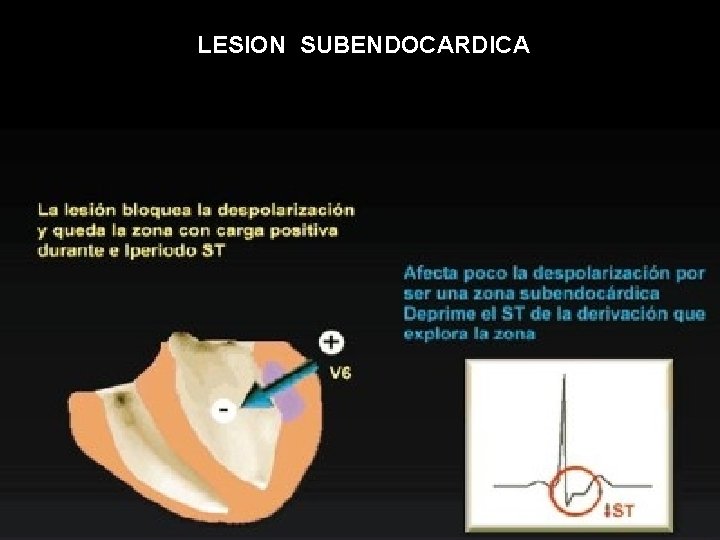 LESION SUBENDOCARDICA 