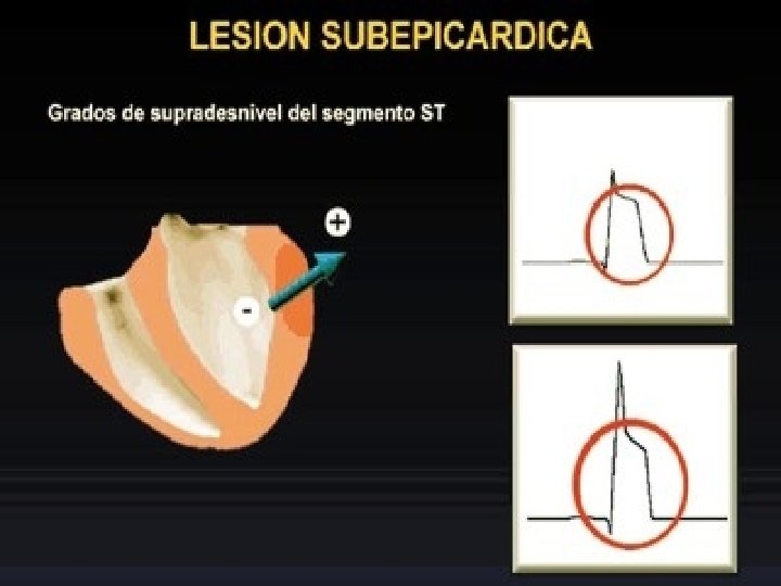 LESION SUBEPICARDICA 