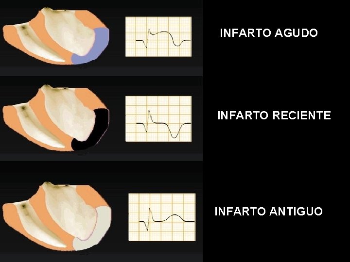 INFARTO AGUDO INFARTO RECIENTE INFARTO ANTIGUO 