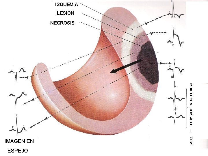 ISQUEMIA LESION NECROSIS R E C U P E R A C I IMAGEN