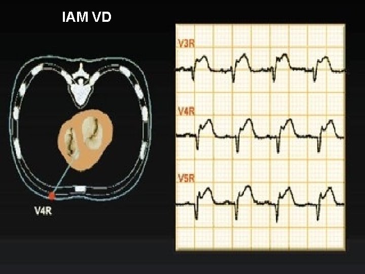 IAM VD 