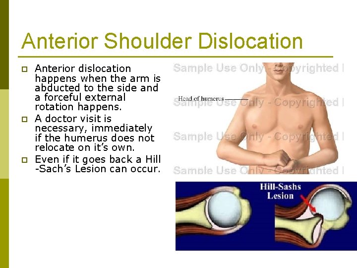 Anterior Shoulder Dislocation p p p Anterior dislocation happens when the arm is abducted