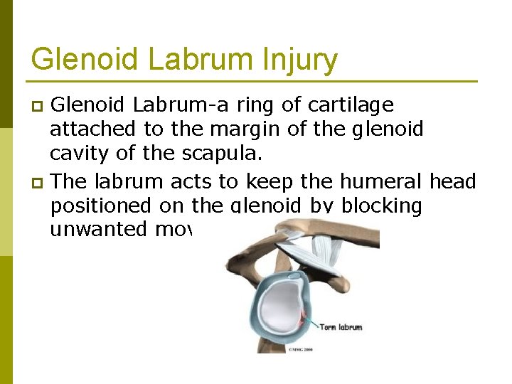 Glenoid Labrum Injury Glenoid Labrum-a ring of cartilage attached to the margin of the