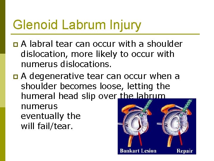 Glenoid Labrum Injury A labral tear can occur with a shoulder dislocation, more likely