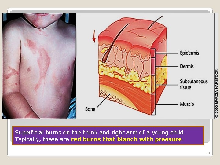 Superficial burns on the trunk and right arm of a young child. Typically, these