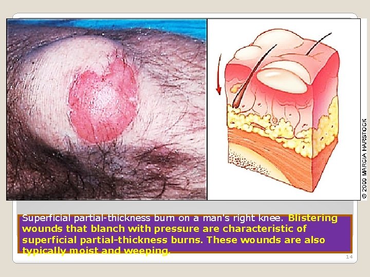 Superficial partial-thickness burn on a man's right knee. Blistering wounds that blanch with pressure