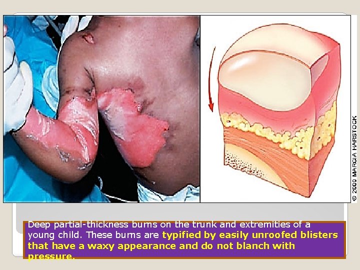 Deep partial-thickness burns on the trunk and extremities of a young child. These burns
