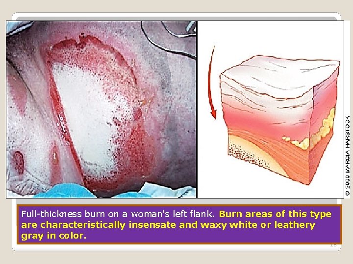 Full-thickness burn on a woman's left flank. Burn areas of this type are characteristically