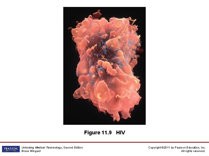 Figure 11. 9 HIV Unlocking Medical Terminology, Second Edition Bruce Wingerd Copyright © 2011