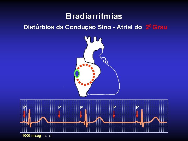 Bradiarritmias Distúrbios da Condução Sino - Atrial do 20 Grau P 1000 mseg FC