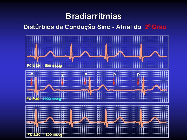 Bradiarritmias Distúrbios da Condução Sino - Atrial do 20 Grau FC ± 80 -