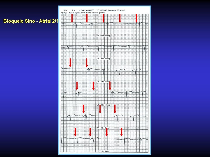 Bloqueio Sino - Atrial 2/1 
