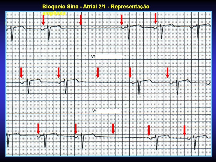 Bloqueio Sino - Atrial 2/1 - Representação ampliada Bloqueio Sino - Atrial 2/1 