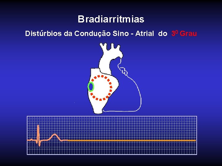 Bradiarritmias Distúrbios da Condução Sino - Atrial do 30 Grau 