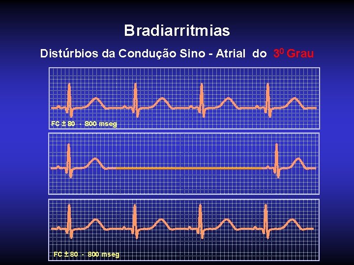 Bradiarritmias Distúrbios da Condução Sino - Atrial do 30 Grau FC ± 80 -