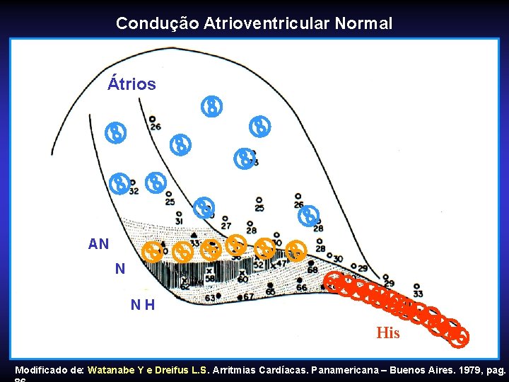 Condução Atrioventricular Normal AN N NH Átrios His Modificado de: Watanabe Y e Dreifus