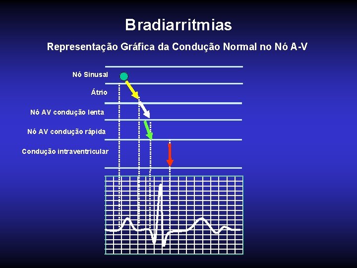 Bradiarritmias Representação Gráfica da Condução Normal no Nó A-V Nó Sinusal Átrio Nó AV