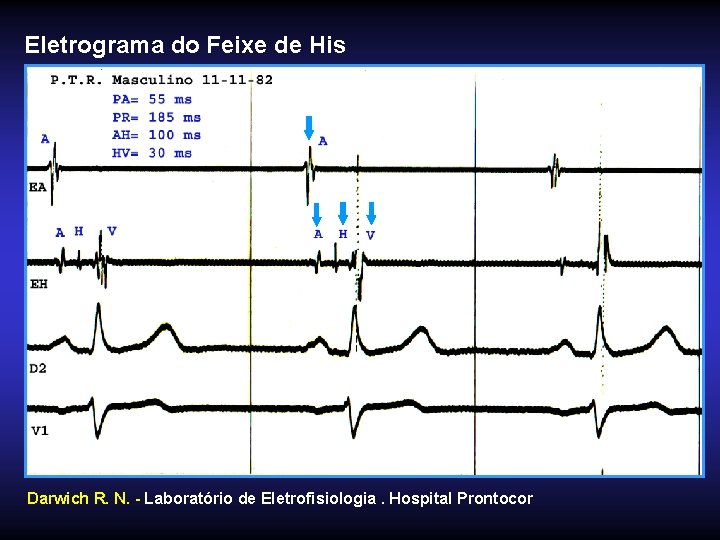 Eletrograma do Feixe de His Darwich R. N. - Laboratório de Eletrofisiologia. Hospital Prontocor