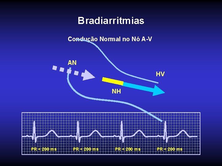 Bradiarritmias Condução Normal no Nó A-V AN HV NH PR < 200 ms 