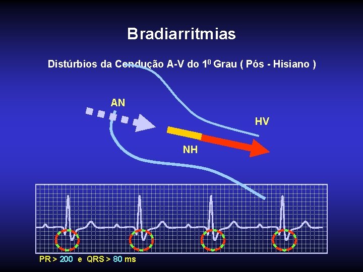 Bradiarritmias Distúrbios da Condução A-V do 10 Grau ( Pós - Hisiano ) AN