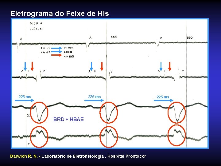 Eletrograma do Feixe de His 225 ms BRD + HBAE Darwich R. N. -