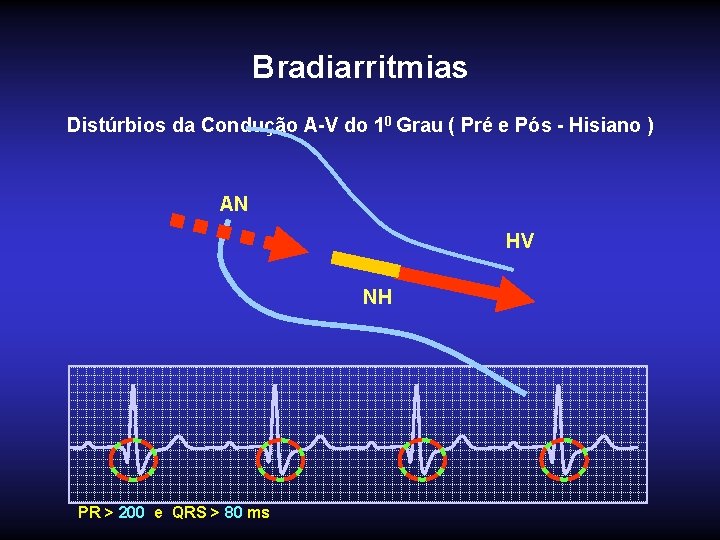 Bradiarritmias Distúrbios da Condução A-V do 10 Grau ( Pré e Pós - Hisiano