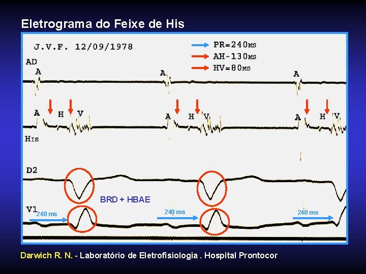 Eletrograma do Feixe de His BRD + HBAE 240 ms Darwich R. N. -