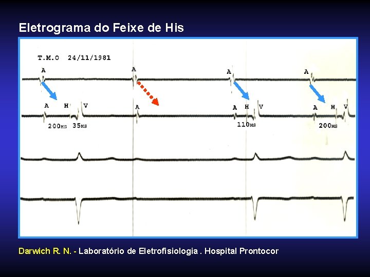 Eletrograma do Feixe de His Darwich R. N. - Laboratório de Eletrofisiologia. Hospital Prontocor