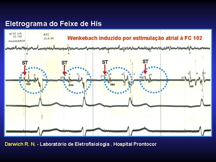 Eletrograma do Feixe de His Wenkebach induzido por estimulação atrial à FC 102 ST