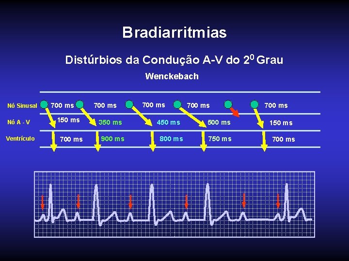 Bradiarritmias Distúrbios da Condução A-V do 20 Grau Wenckebach Nó Sinusal Nó A -