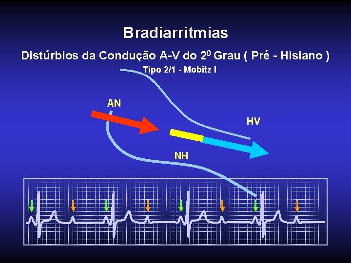Bradiarritmias Distúrbios da Condução A-V do 20 Grau ( Pré - Hisiano ) Tipo
