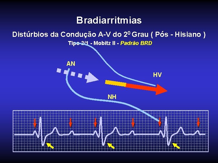 Bradiarritmias Distúrbios da Condução A-V do 20 Grau ( Pós - Hisiano ) Tipo